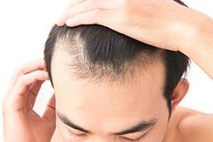 proscar for hair loss side effects